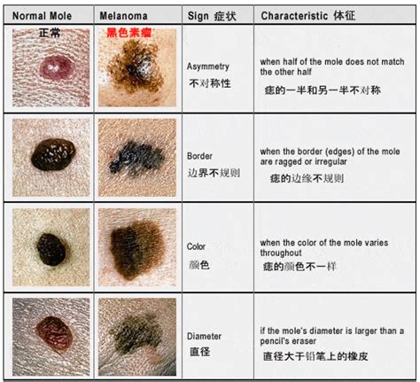 身上痣|点痣不正规可能引发癌变：关于痣的 4 个常识